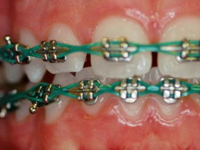 orthodontic parts